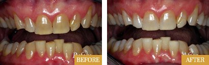 Bleaching Before After 02 - Westlake Family Dentistry