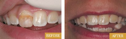 Dental Bonding Treatment: A Good Option for Sensitive Teeth - Stunning  Smiles of Lake Forest Lake Forest California