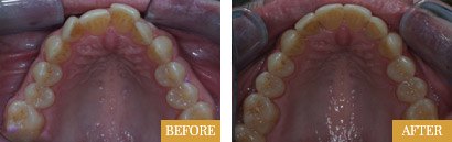 Six Month Smiles Before After 01 - Westlake Family Dentistry