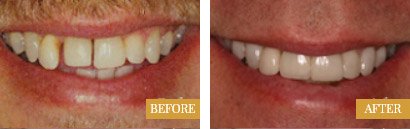Smile Makeovers Before After 01 - Westlake Family Dentistry