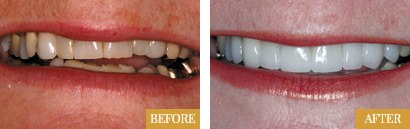 Smile Makeovers Before After 02 - Westlake Family Dentistry