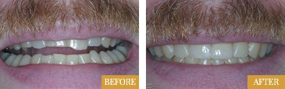 Smile Makeovers Before After 03 - Westlake Family Dentistry