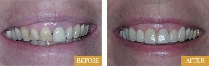 Smile Makeovers Before After 05 - Westlake Family Dentistry