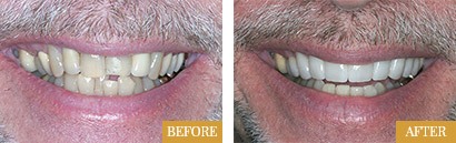 Smile Makeovers Before After 06 - Westlake Family Dentistry