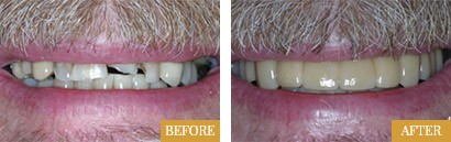 Smile Makeovers Before After 07 - Westlake Family Dentistry