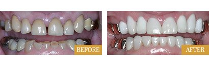 Smile Makeovers Before After 08 - Westlake Family Dentistry