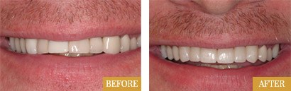 Smile Makeovers Before After 09 - Westlake Family Dentistry