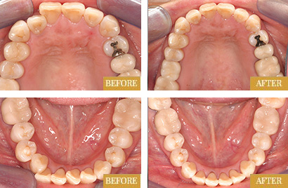 Invisalign before after results of actual patients - result set 1