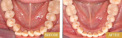 Invisalign before after results of actual patients at Lake Oswego, Oregon - result set 1