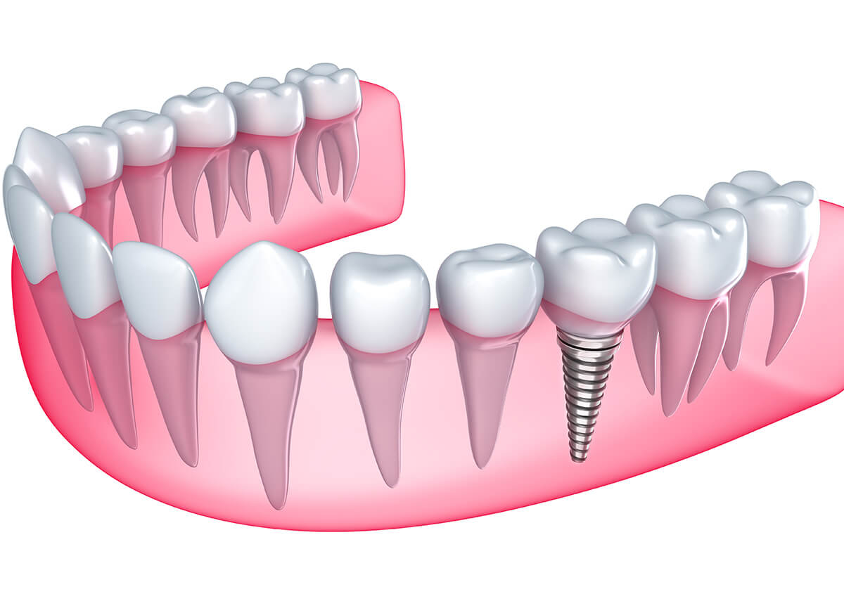 Teeth Implants Dentist in Lake Oswego Area