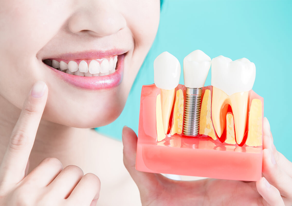 Dental Implants Services in Lake Oswego OR Area
