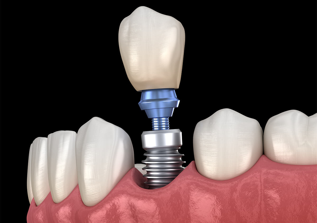 Implants Dentist in Lake Oswego OR Area