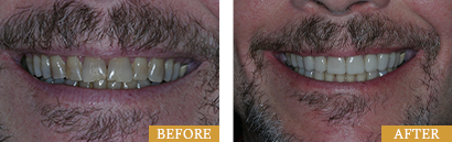 Smile Makeovers Before After 10 - Westlake Family Dentistry