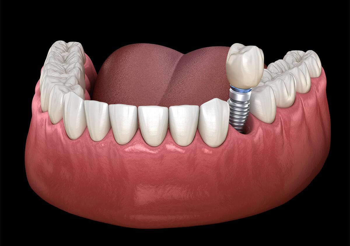 Teeth Implant Dentist in Lake Oswego Area