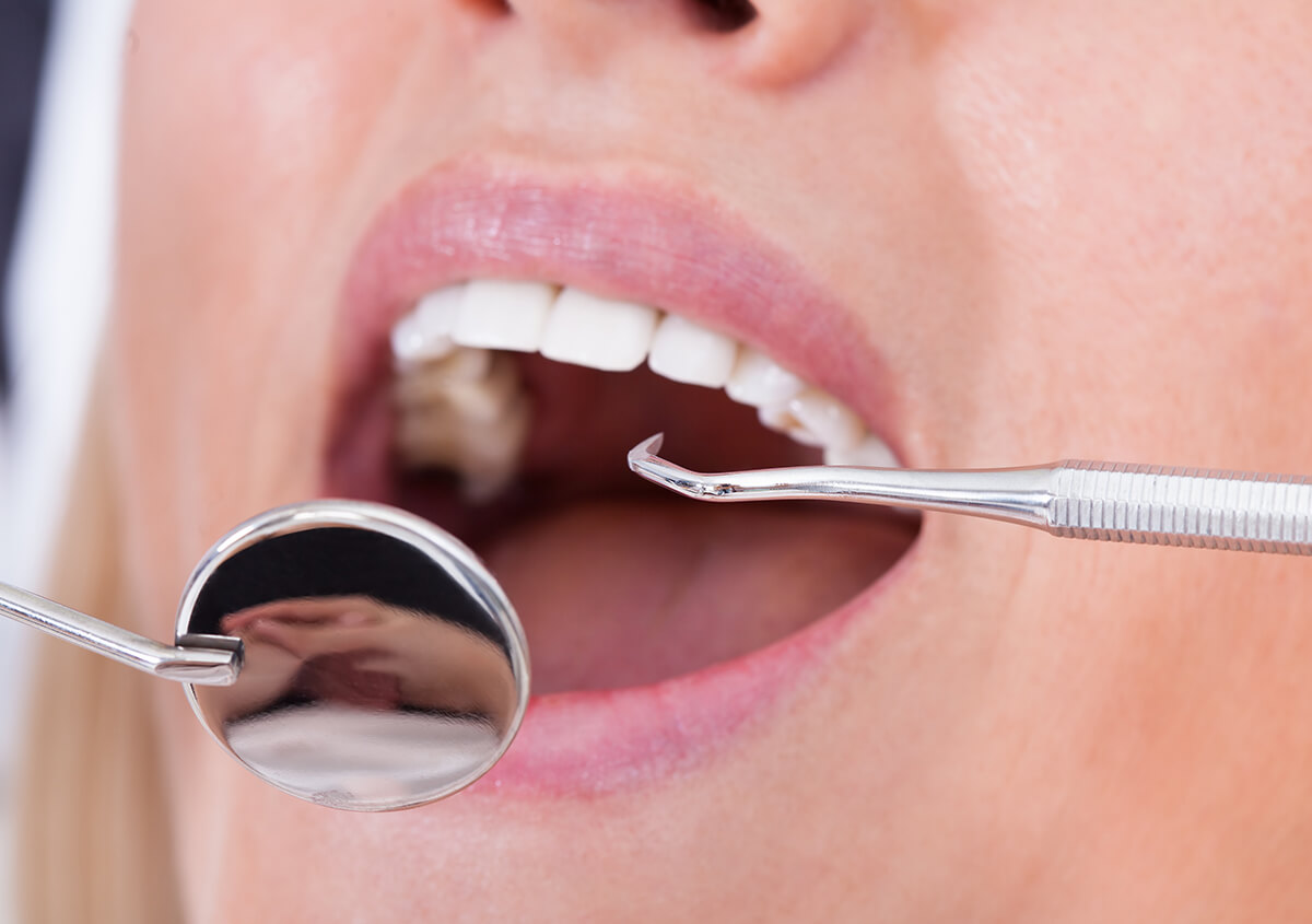 Is Dental Sealant Better Than Cavity Filling in Lake Oswego Area