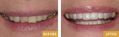 Smile Makeover - Before & After 7