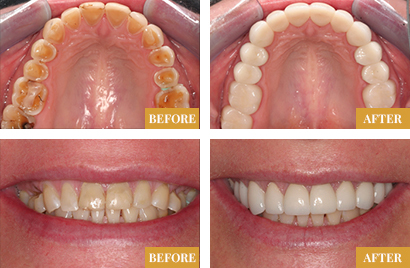 Smile Makeover - Before & After 8