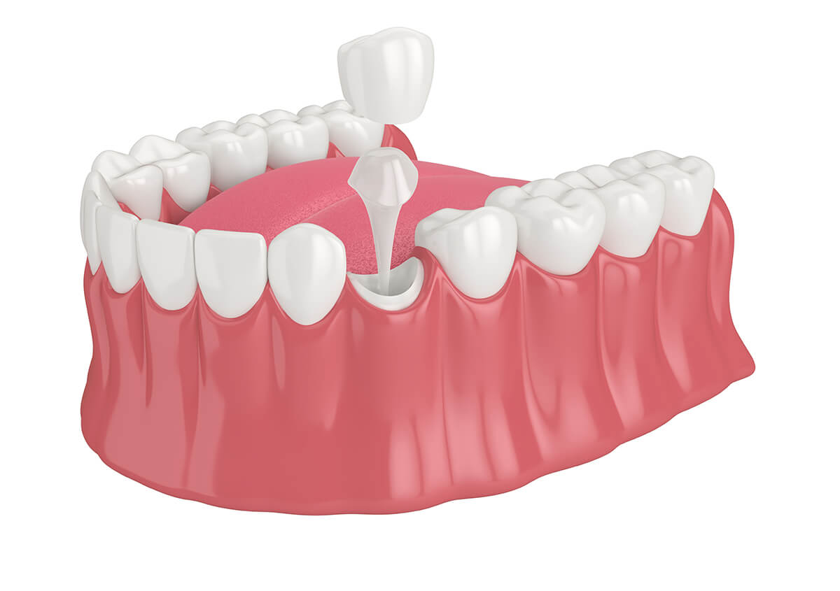Porcelain Tooth Crown in Lake Oswego OR Area